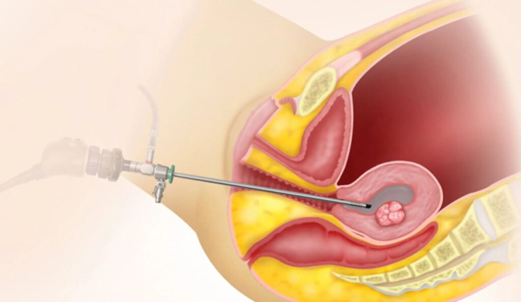 hysteroscopy